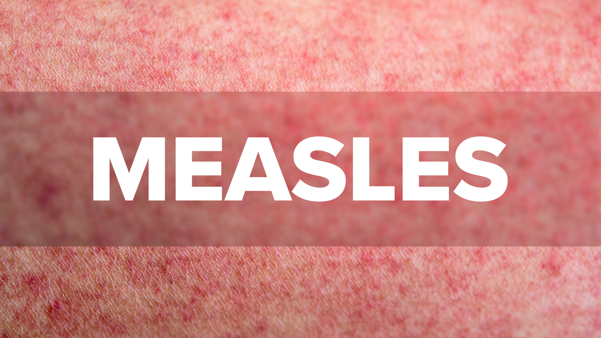 First measles case reported in Indiana in five years